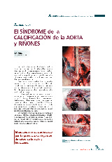 El síndrome de la calcificación de la aorta y riñones